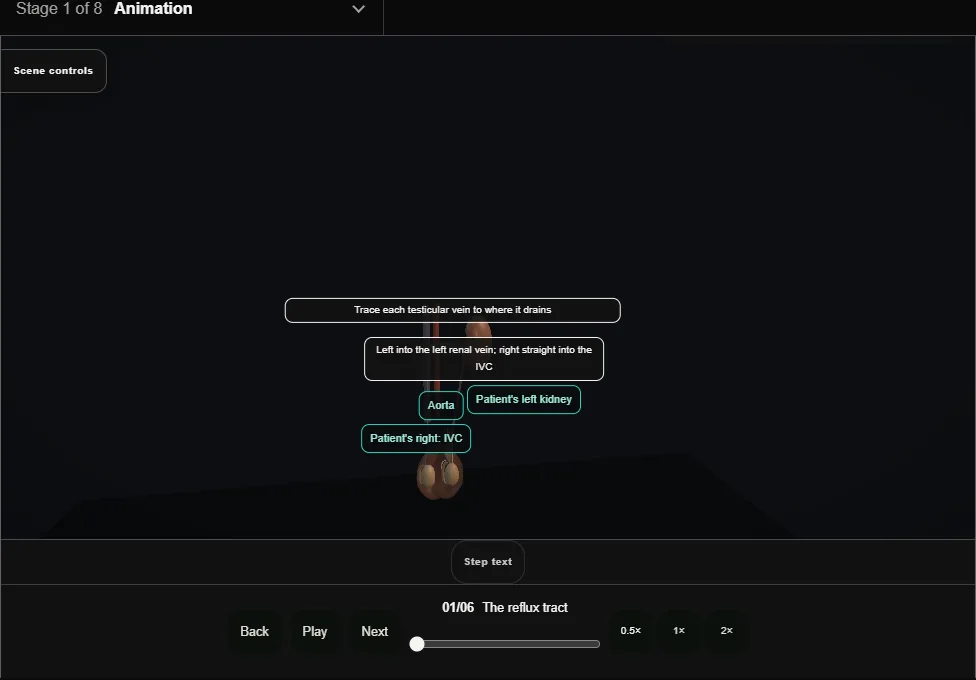 Varicocele: embolisation or ligation. Step 1: The reflux tract. Captured frame from the interactive animation.