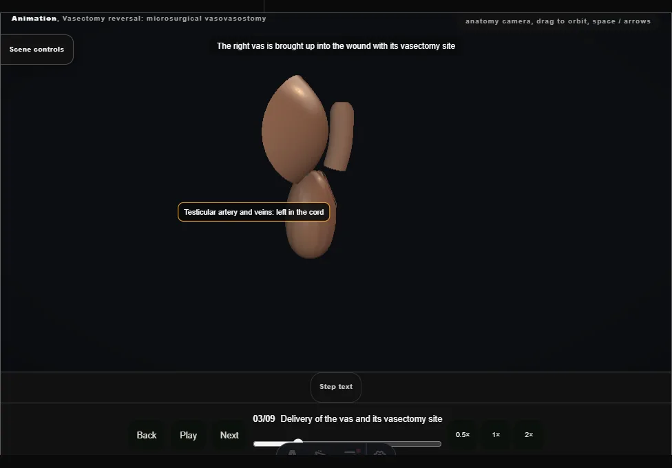 Vasectomy reversal: microsurgical vasovasostomy. Step 3: Delivery of the vas and its vasectomy site. Captured frame from the interactive animation.