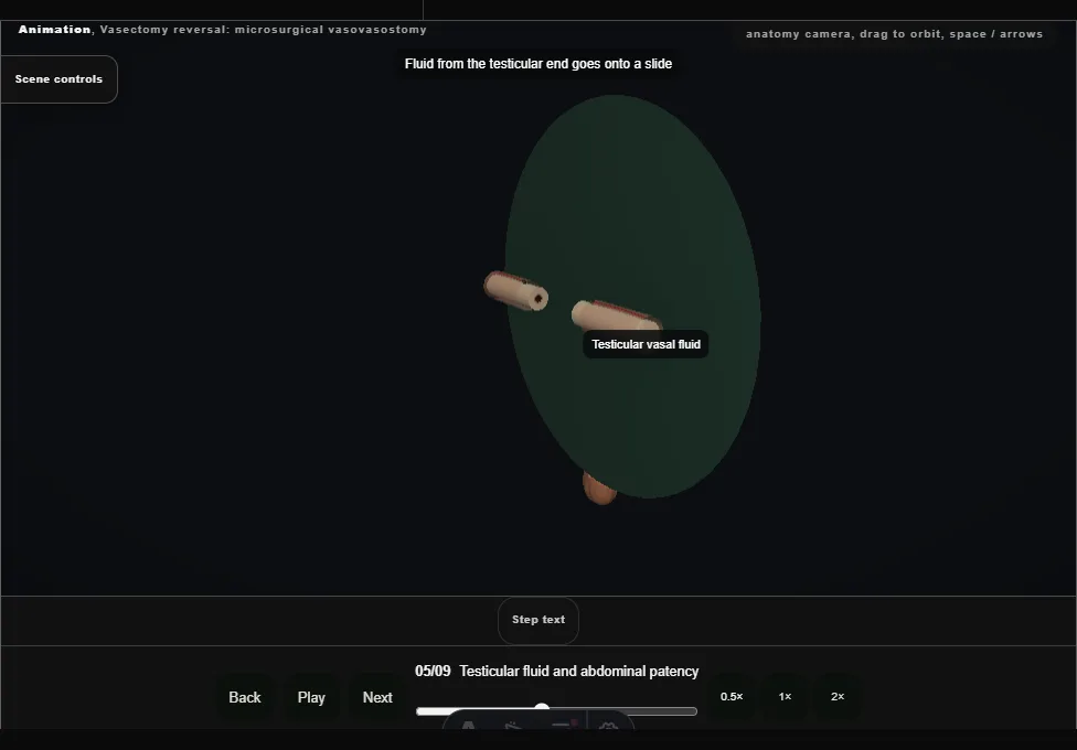 Vasectomy reversal: microsurgical vasovasostomy. Step 5: Testicular fluid and abdominal patency. Captured frame from the interactive animation.