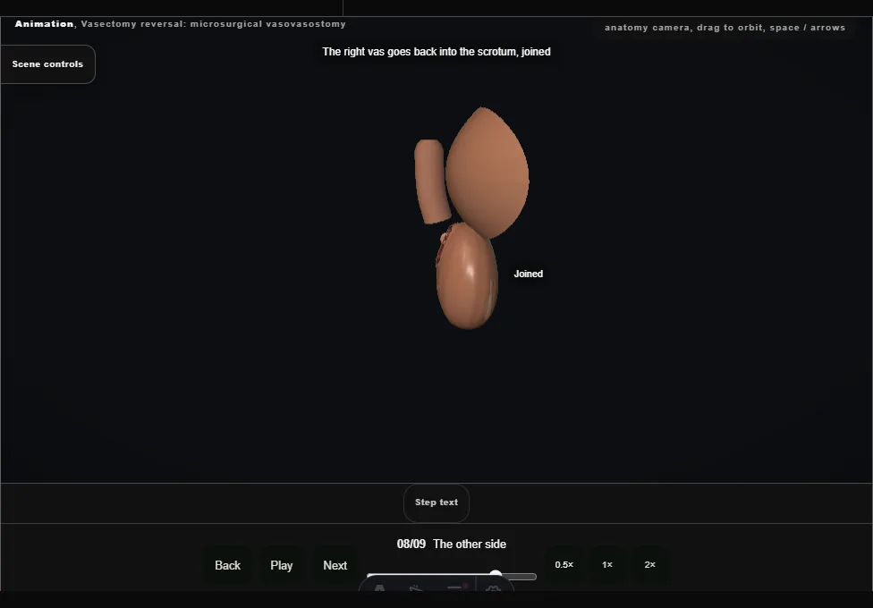 Vasectomy reversal: microsurgical vasovasostomy. Step 8: The other side. Captured frame from the interactive animation.