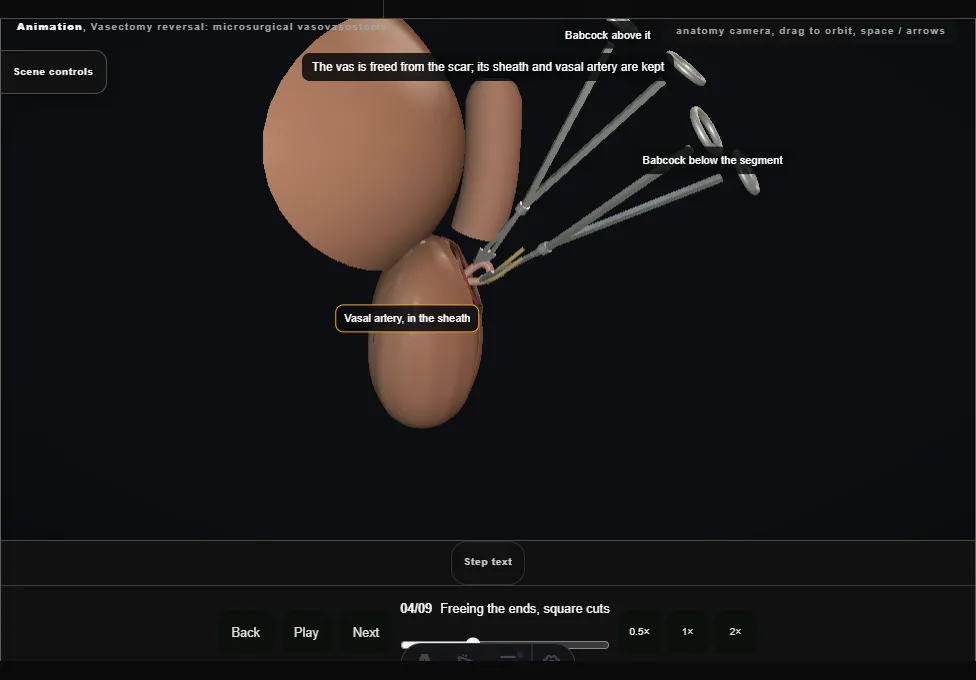 Vasectomy reversal: microsurgical vasovasostomy. Step 4: Freeing the ends, square cuts. Captured frame from the interactive animation.