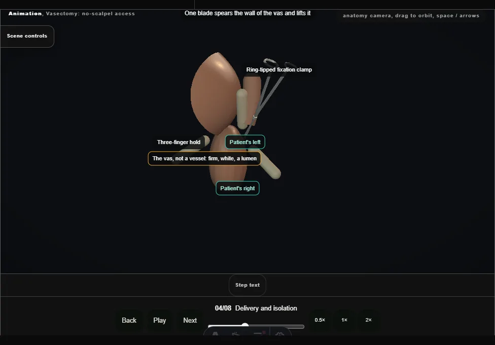 Vasectomy: no-scalpel access. Step 4: Delivery and isolation. Captured frame from the interactive animation.