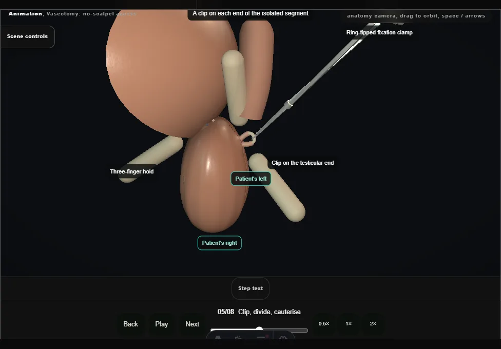 Vasectomy: no-scalpel access. Step 5: Clip, divide, cauterise. Captured frame from the interactive animation.