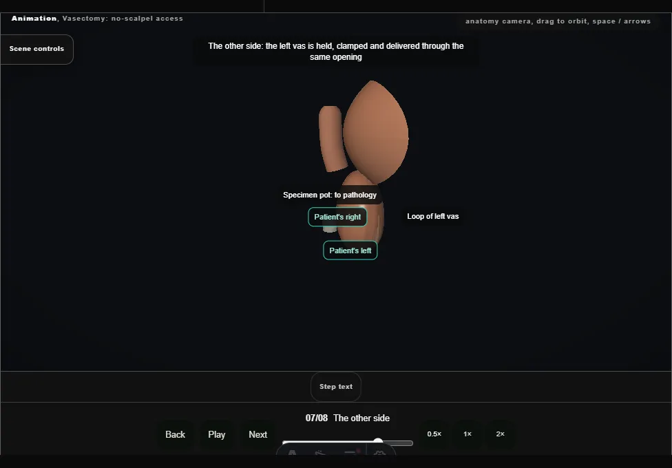 Vasectomy: no-scalpel access. Step 7: The other side. Captured frame from the interactive animation.