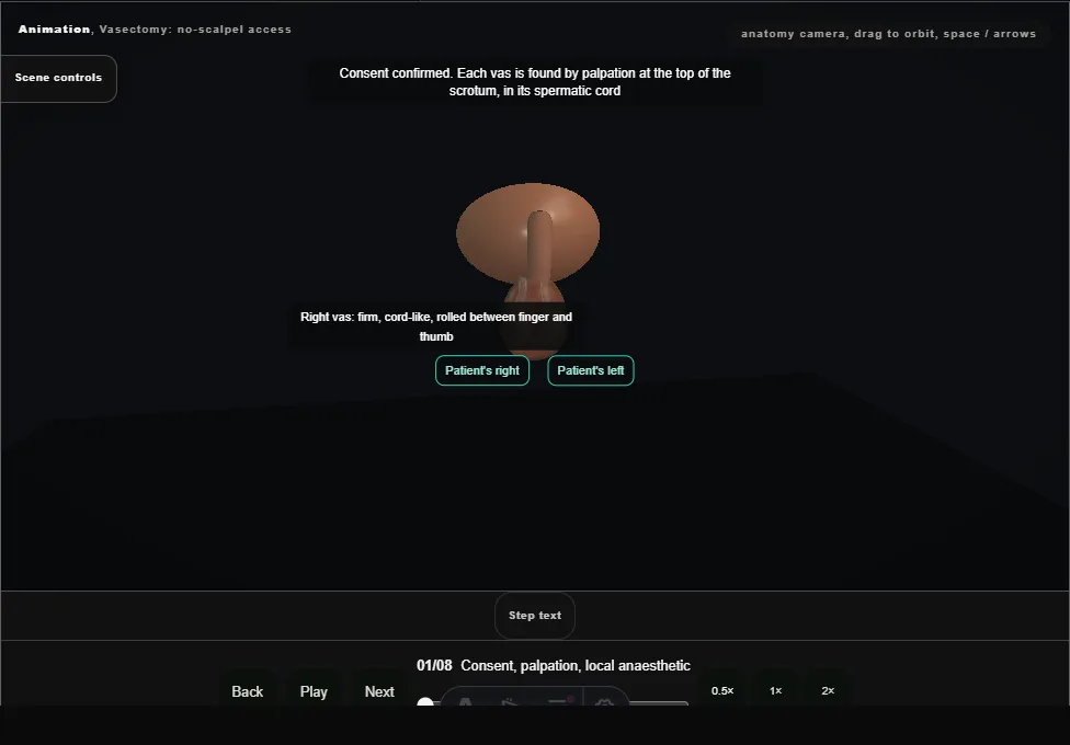 Vasectomy: no-scalpel access. Step 1: Consent, palpation, local anaesthetic. Captured frame from the interactive animation.
