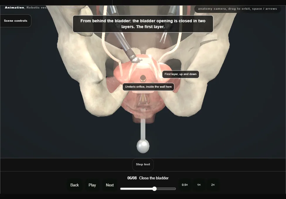Robotic vesicovaginal fistula repair. Step 6: Close the bladder. Captured frame from the interactive animation.