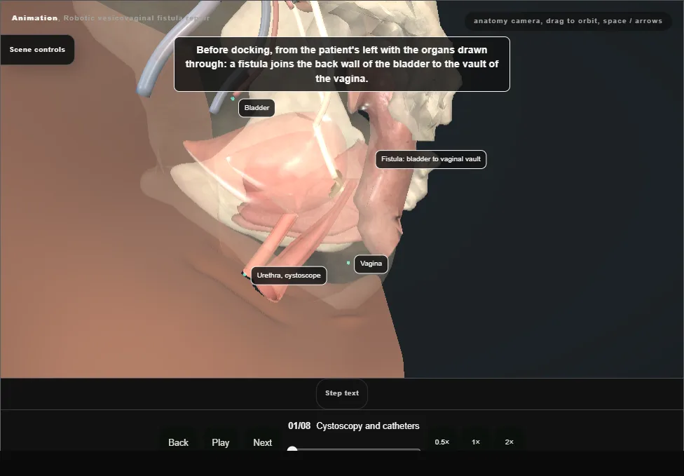 Robotic vesicovaginal fistula repair. Step 1: Cystoscopy and catheters. Captured frame from the interactive animation.