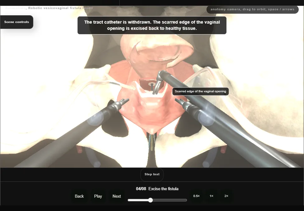 Robotic vesicovaginal fistula repair. Step 4: Excise the fistula. Captured frame from the interactive animation.