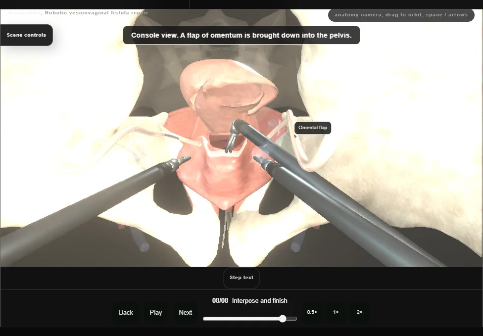 Robotic vesicovaginal fistula repair. Step 8: Interpose and finish. Captured frame from the interactive animation.
