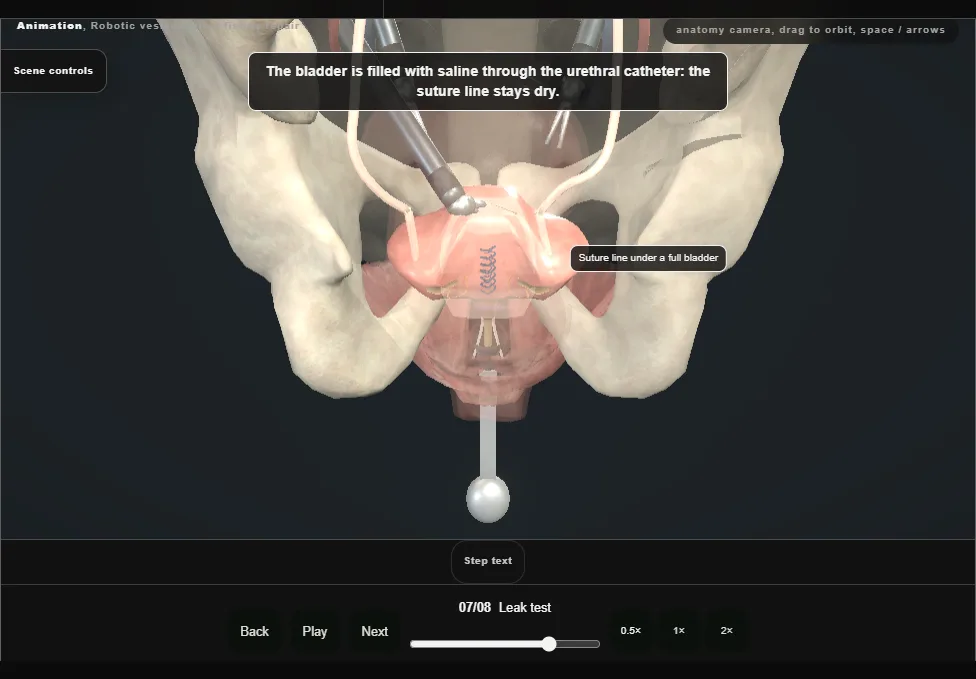 Robotic vesicovaginal fistula repair. Step 7: Leak test. Captured frame from the interactive animation.