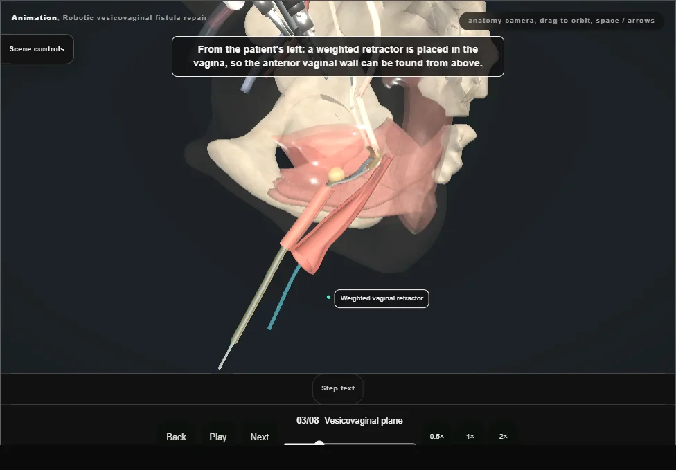 Robotic vesicovaginal fistula repair. Step 3: Vesicovaginal plane. Captured frame from the interactive animation.