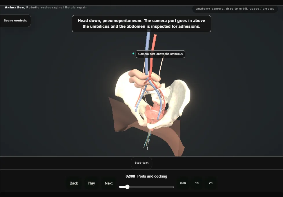 Robotic vesicovaginal fistula repair. Step 2: Ports and docking. Captured frame from the interactive animation.