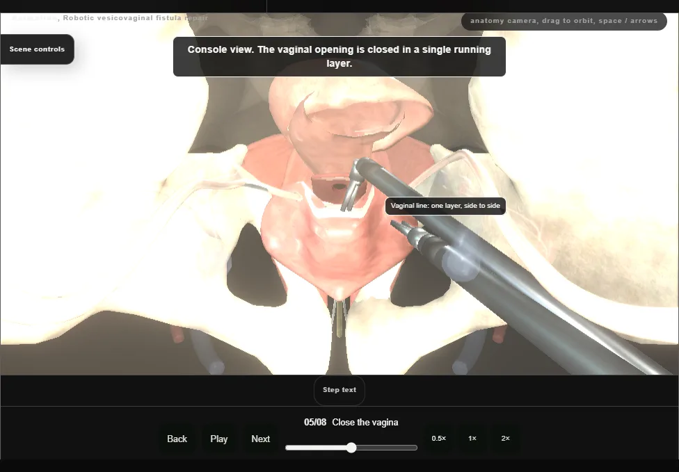 Robotic vesicovaginal fistula repair. Step 5: Close the vagina. Captured frame from the interactive animation.
