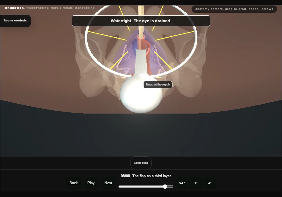 Vesicovaginal fistula repair, transvaginal. Step 8: The flap as a third layer. Captured frame from the interactive animation.