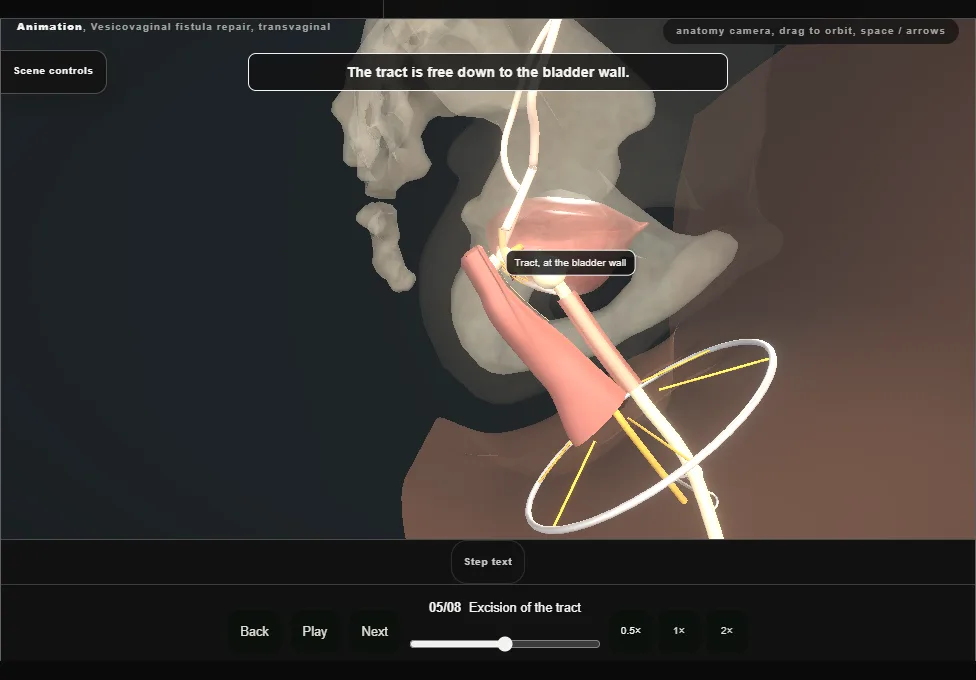 Vesicovaginal fistula repair, transvaginal. Step 5: Excision of the tract. Captured frame from the interactive animation.