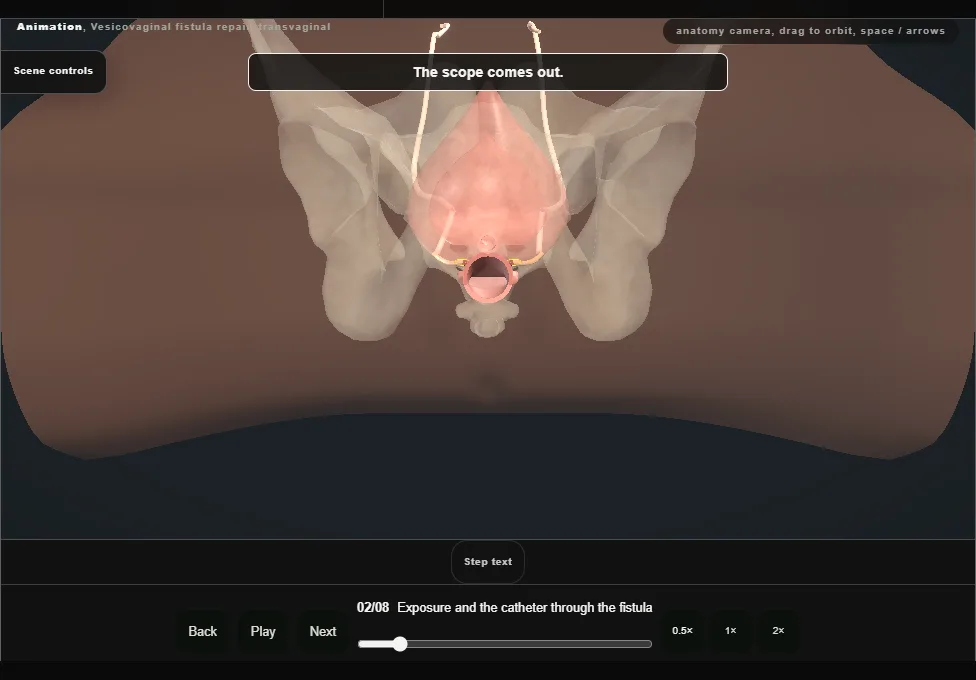 Vesicovaginal fistula repair, transvaginal. Step 2: Exposure and the catheter through the fistula. Captured frame from the interactive animation.