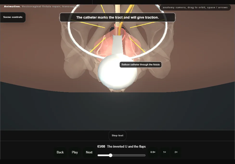 Vesicovaginal fistula repair, transvaginal. Step 3: The inverted U and the flaps. Captured frame from the interactive animation.