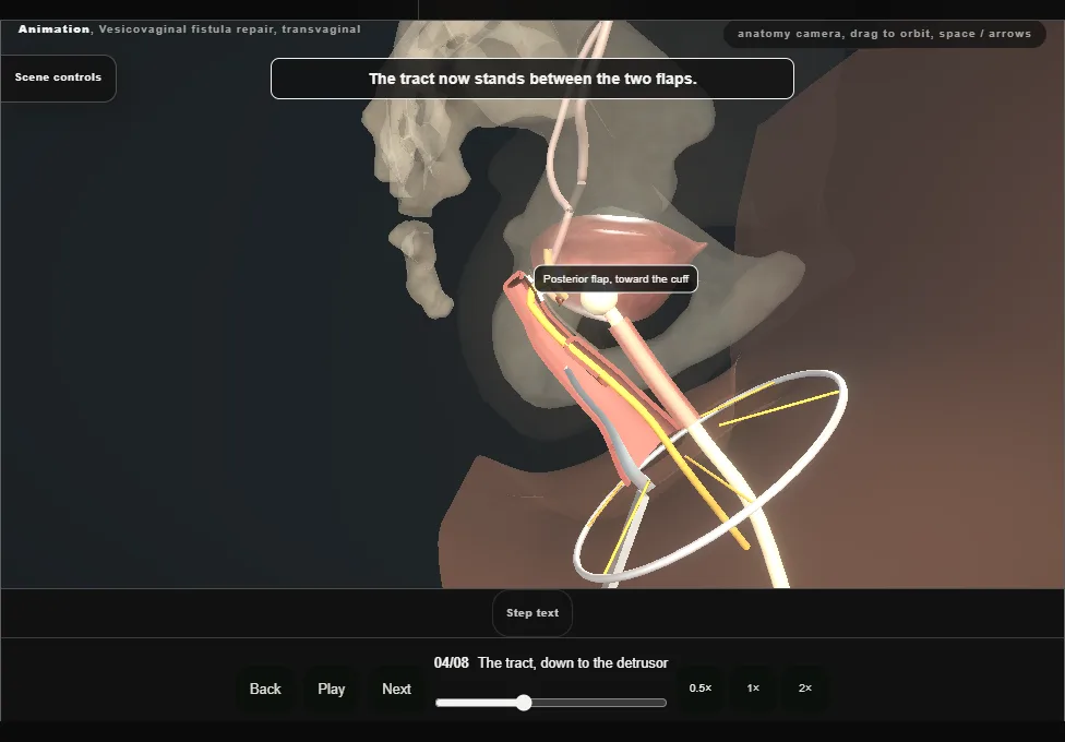 Vesicovaginal fistula repair, transvaginal. Step 4: The tract, down to the detrusor. Captured frame from the interactive animation.