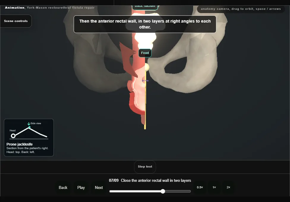 York-Mason rectourethral fistula repair. Step 7: Close the anterior rectal wall in two layers. Captured frame from the interactive animation.