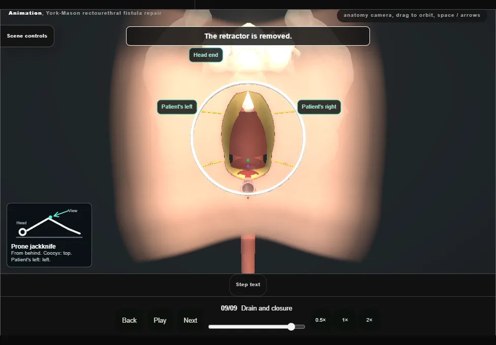 York-Mason rectourethral fistula repair. Step 9: Drain and closure. Captured frame from the interactive animation.