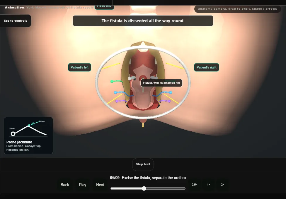 York-Mason rectourethral fistula repair. Step 5: Excise the fistula, separate the urethra. Captured frame from the interactive animation.