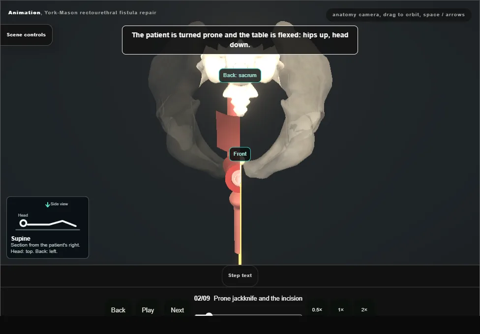 York-Mason rectourethral fistula repair. Step 2: Prone jackknife and the incision. Captured frame from the interactive animation.
