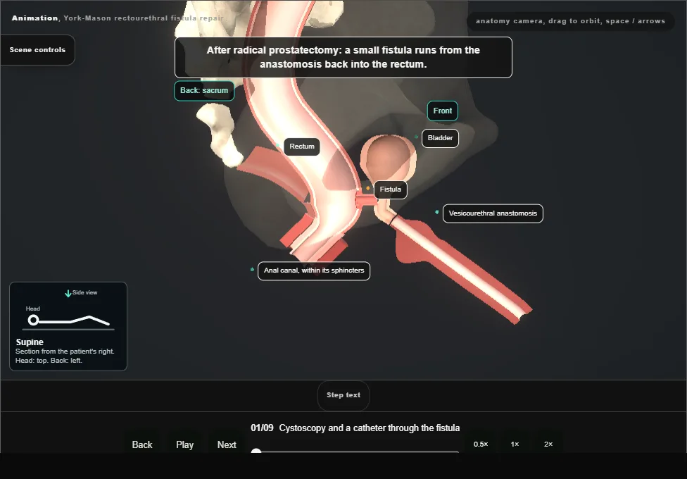 York-Mason rectourethral fistula repair. Step 1: Cystoscopy and a catheter through the fistula. Captured frame from the interactive animation.