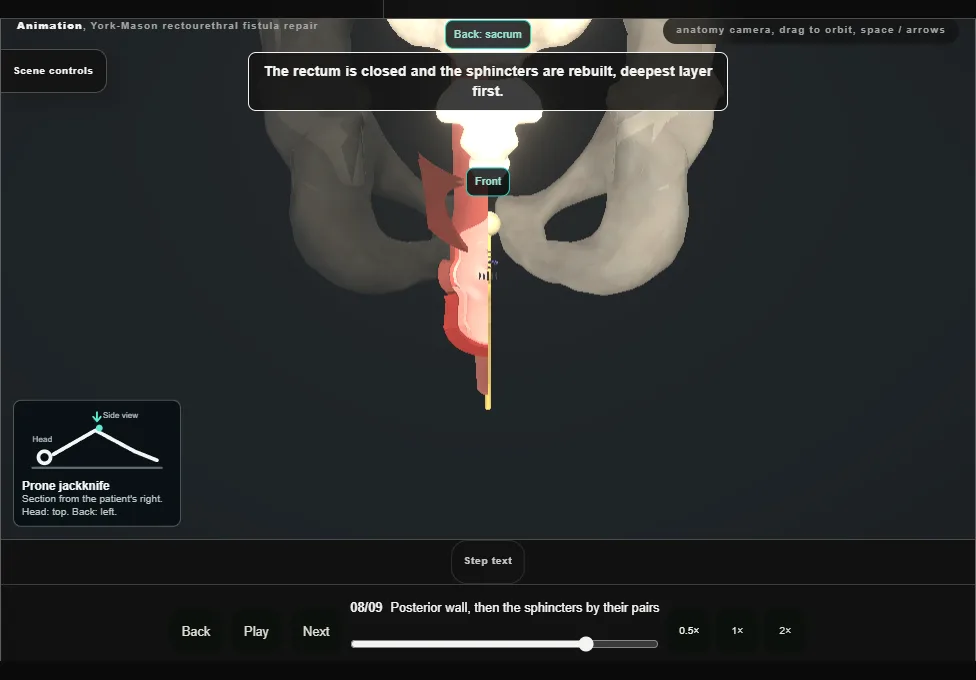 York-Mason rectourethral fistula repair. Step 8: Posterior wall, then the sphincters by their pairs. Captured frame from the interactive animation.