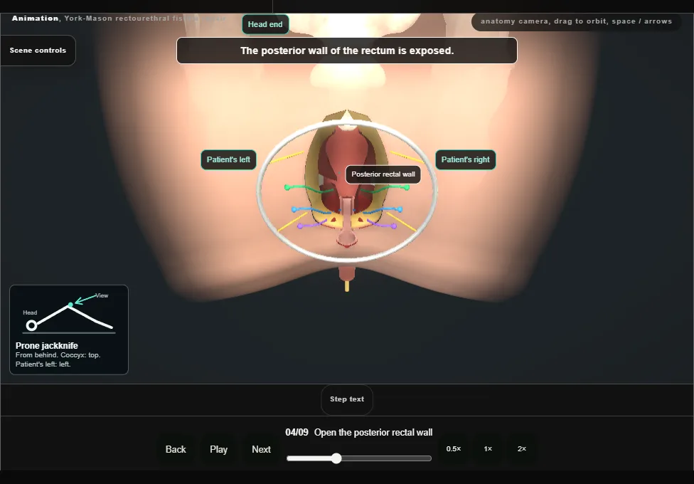 York-Mason rectourethral fistula repair. Step 4: Open the posterior rectal wall. Captured frame from the interactive animation.