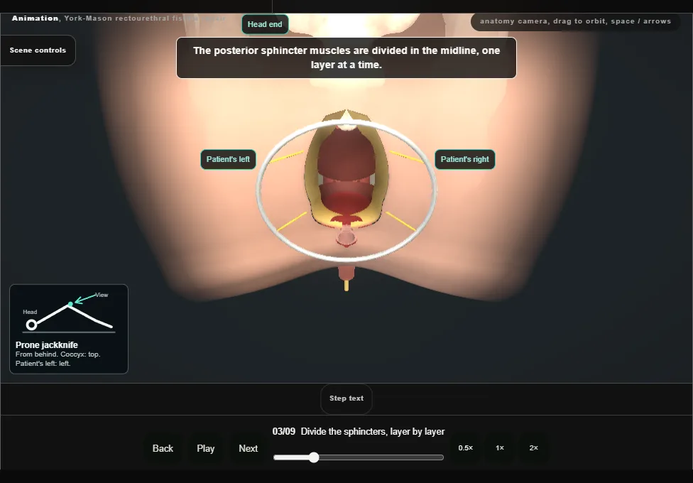 York-Mason rectourethral fistula repair. Step 3: Divide the sphincters, layer by layer. Captured frame from the interactive animation.