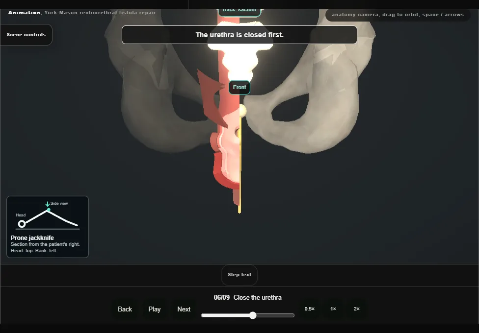 York-Mason rectourethral fistula repair. Step 6: Close the urethra. Captured frame from the interactive animation.